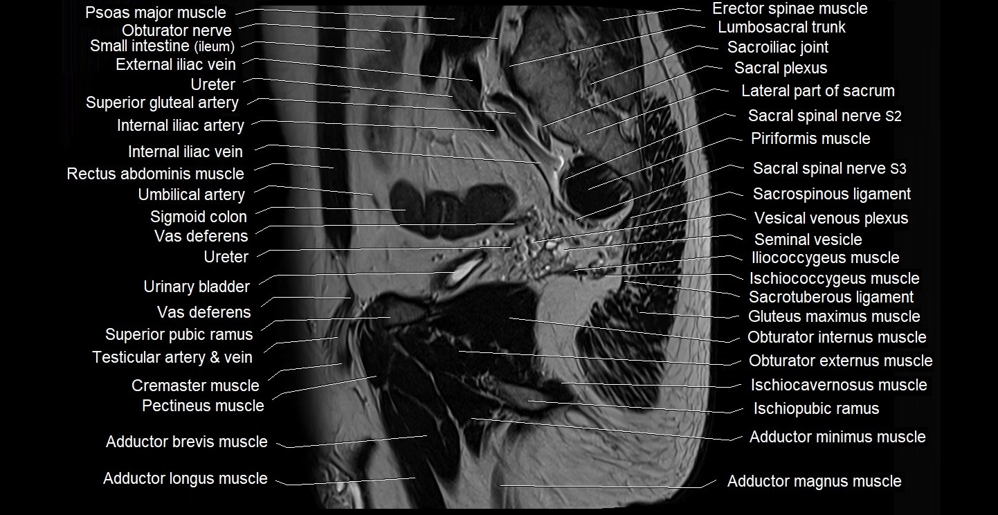 male pelvis sagittal cross sectional anatomy 3T mri image 14.webp